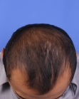 Before Hair Transplant&nbsp;2 Sessions (Areas)